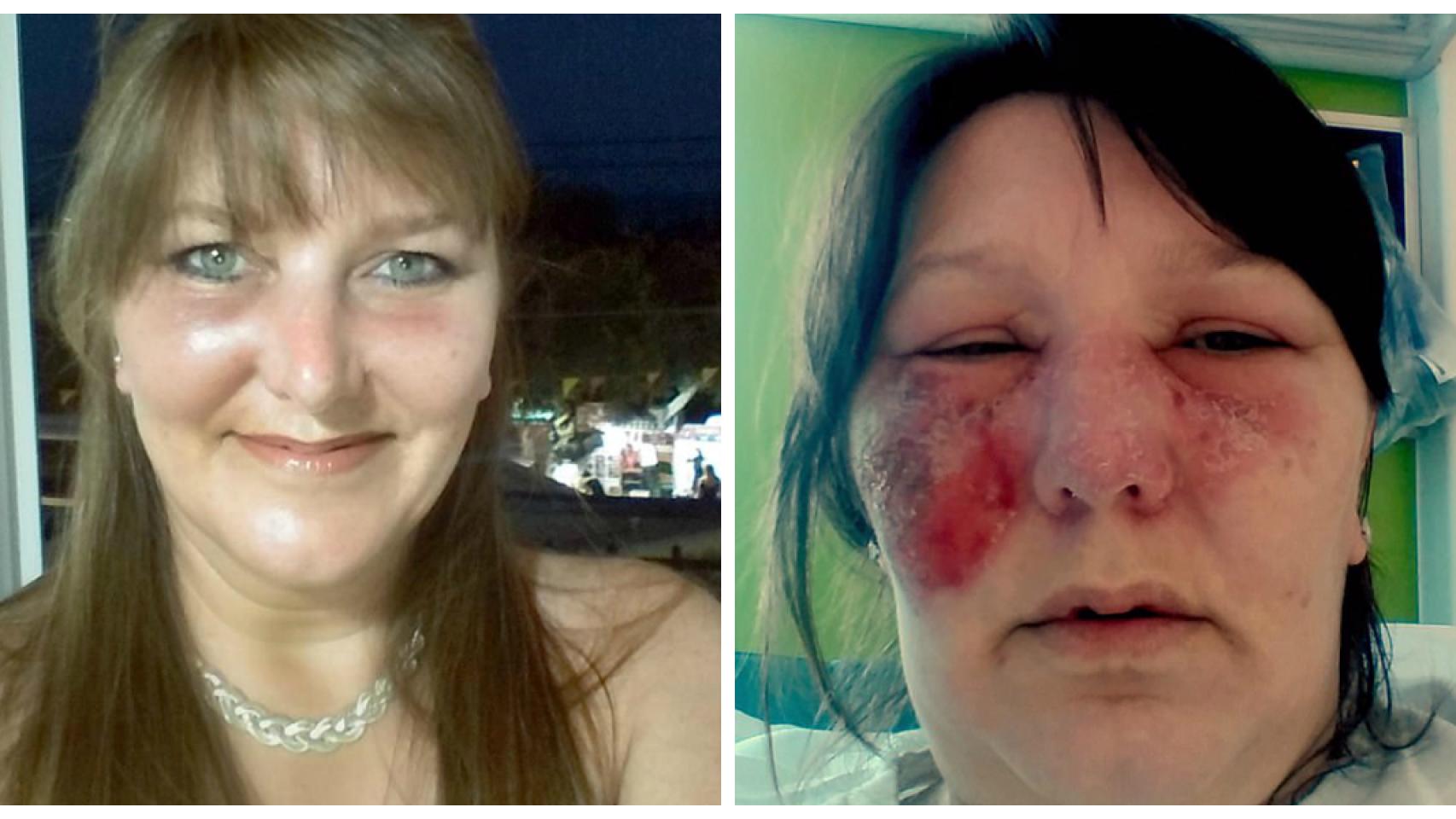 Aspecto normal de Anita Clark e imagen tomada mientras sufría celulitis infecciosa.