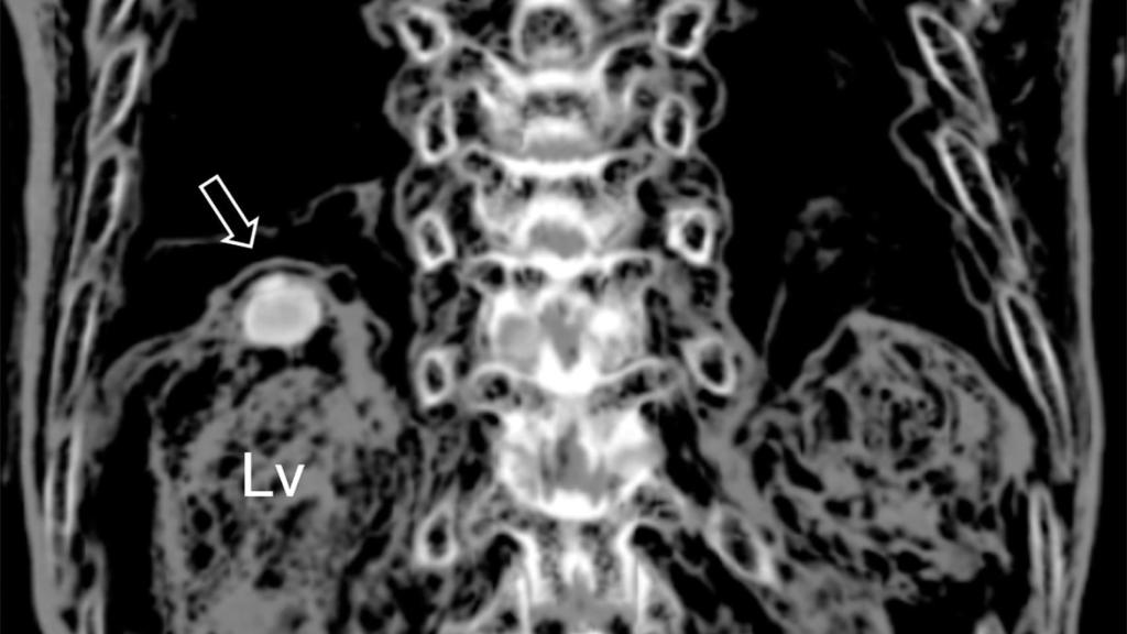 La infección detectada en el hígado de la momia.