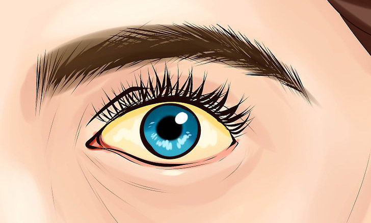 cancer de pancreas ojos amarillos