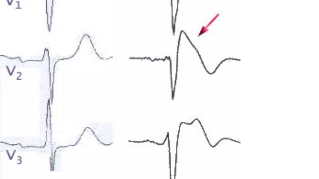 La aleta de tiburón que señala la presencia del Síndrome de Brugada.