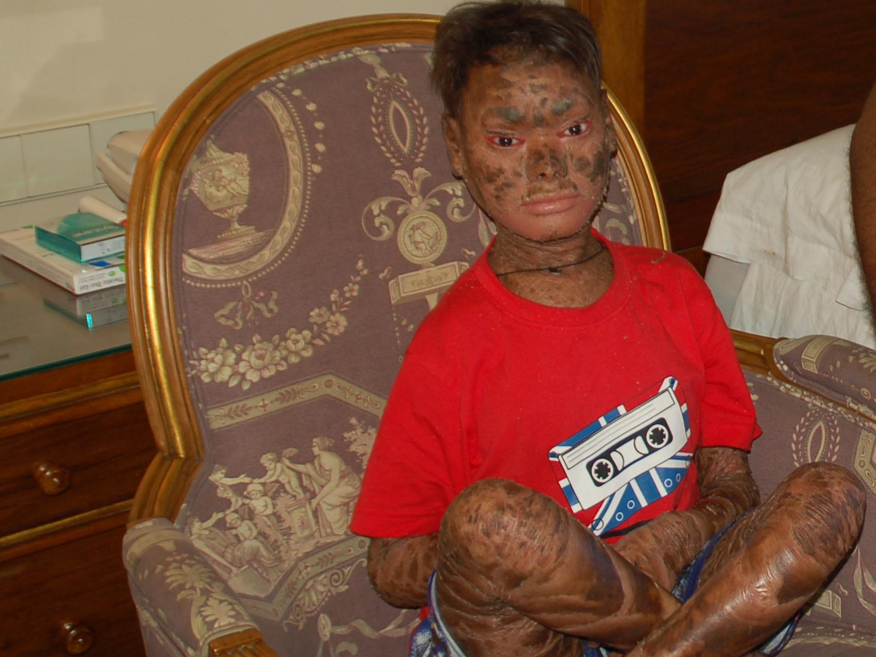 Shalini sufre una enfermedad genética rara llamada ictiosis lamelar.