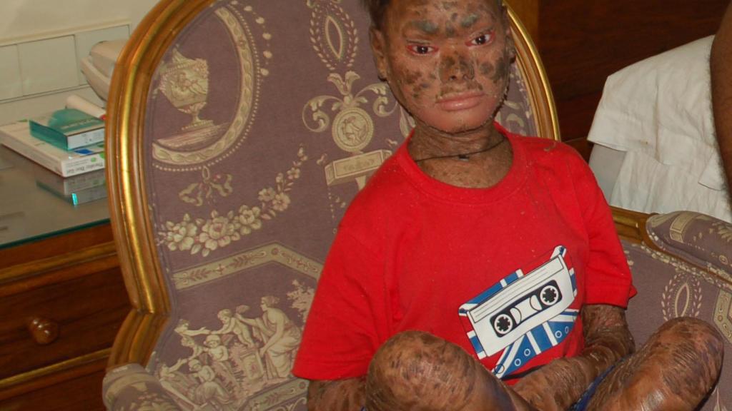 Shalini durante su estancia en la Costa del Sol, cuando apenas había iniciado el tratamiento.