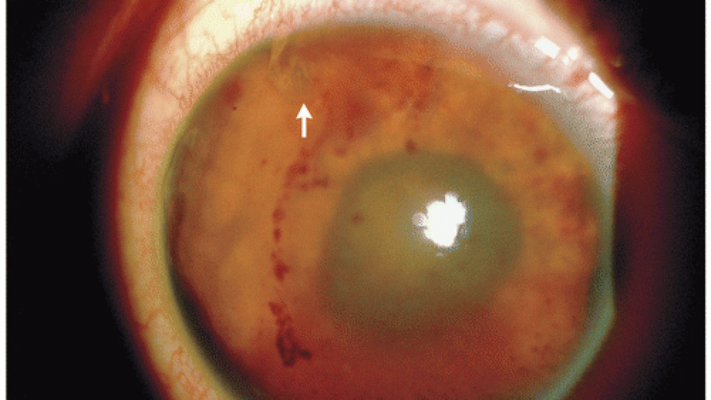 El gusano escondiéndose en su ojo.