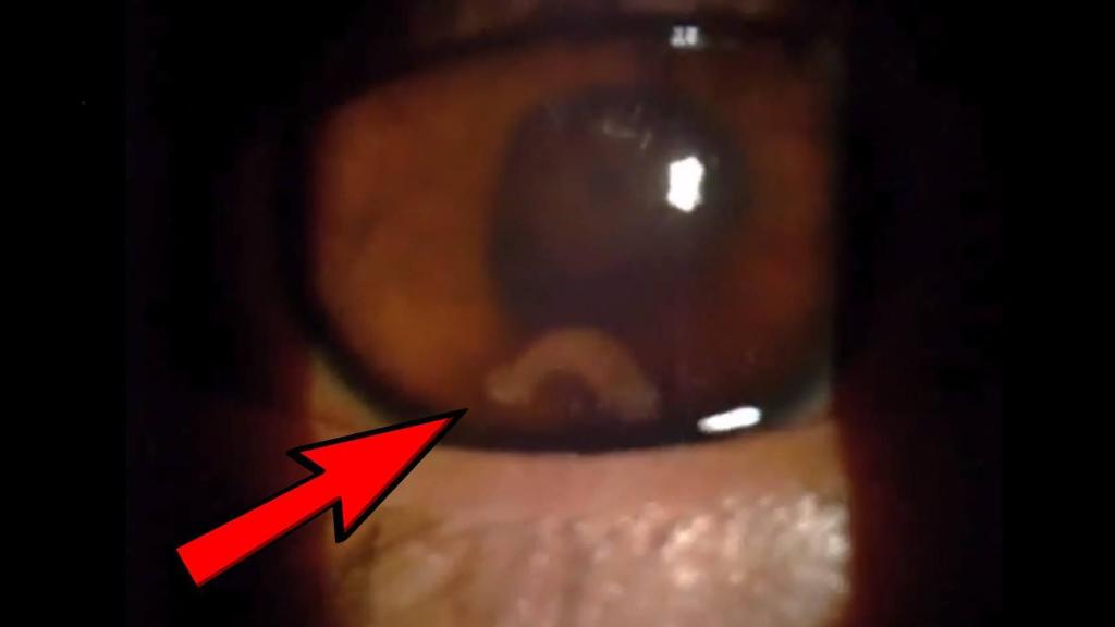 El parásito observado durante la exploración.