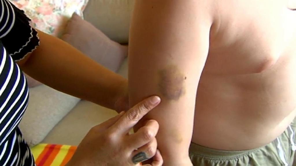 Una de las contusiones sufridas por Elías fruto de la paliza.