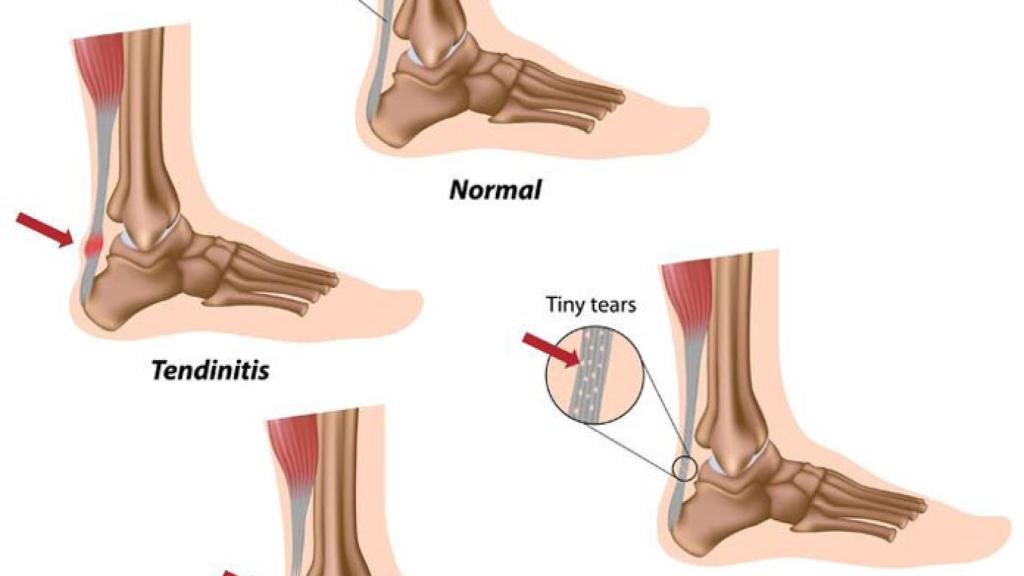tendon-aquiles
