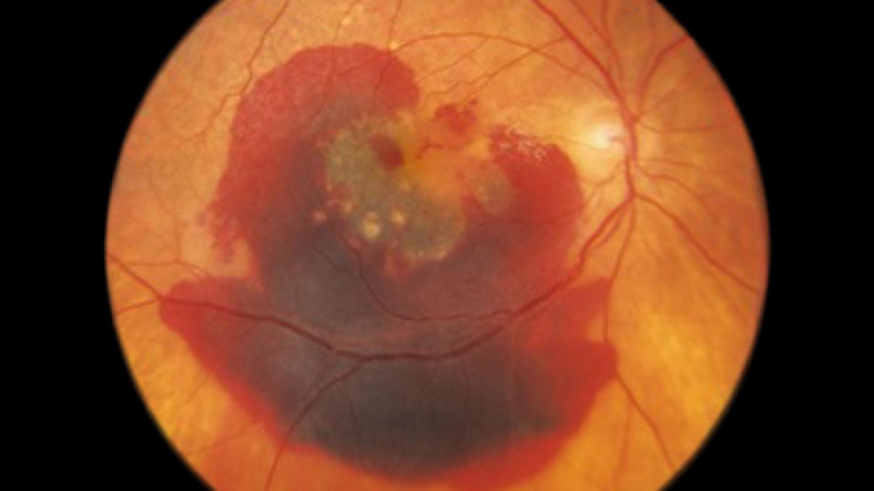 Un globo ocular con degeneración macular.