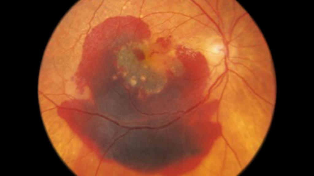 Un globo ocular con degeneración macular.