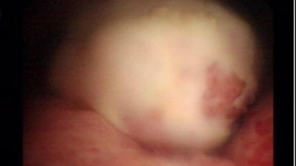 Imagen de la vejiga del paciente vista a través de una cistoscopia.