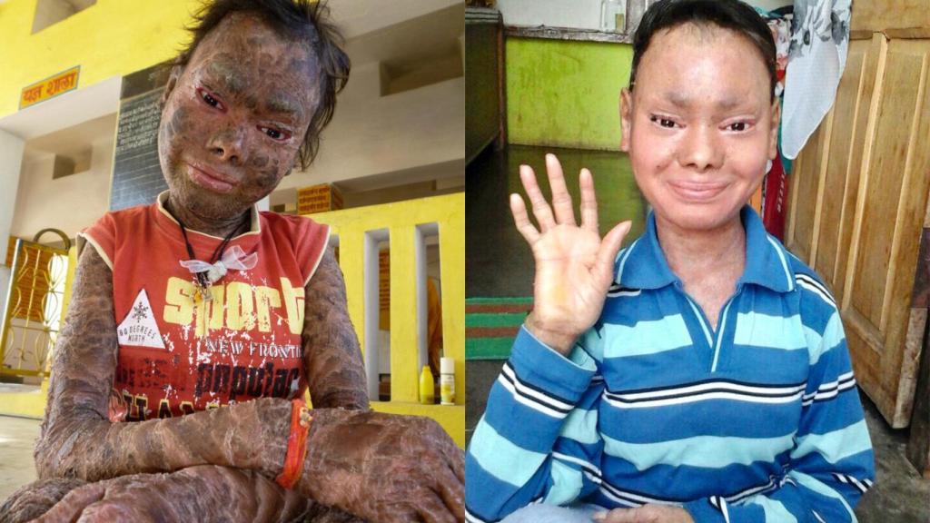 Shalini Yadav antes de venir a Málaga y un mes después de iniciar el tratamiento.