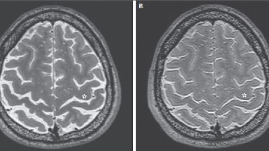 Así cambió el cerebro de uno de los astronautas.