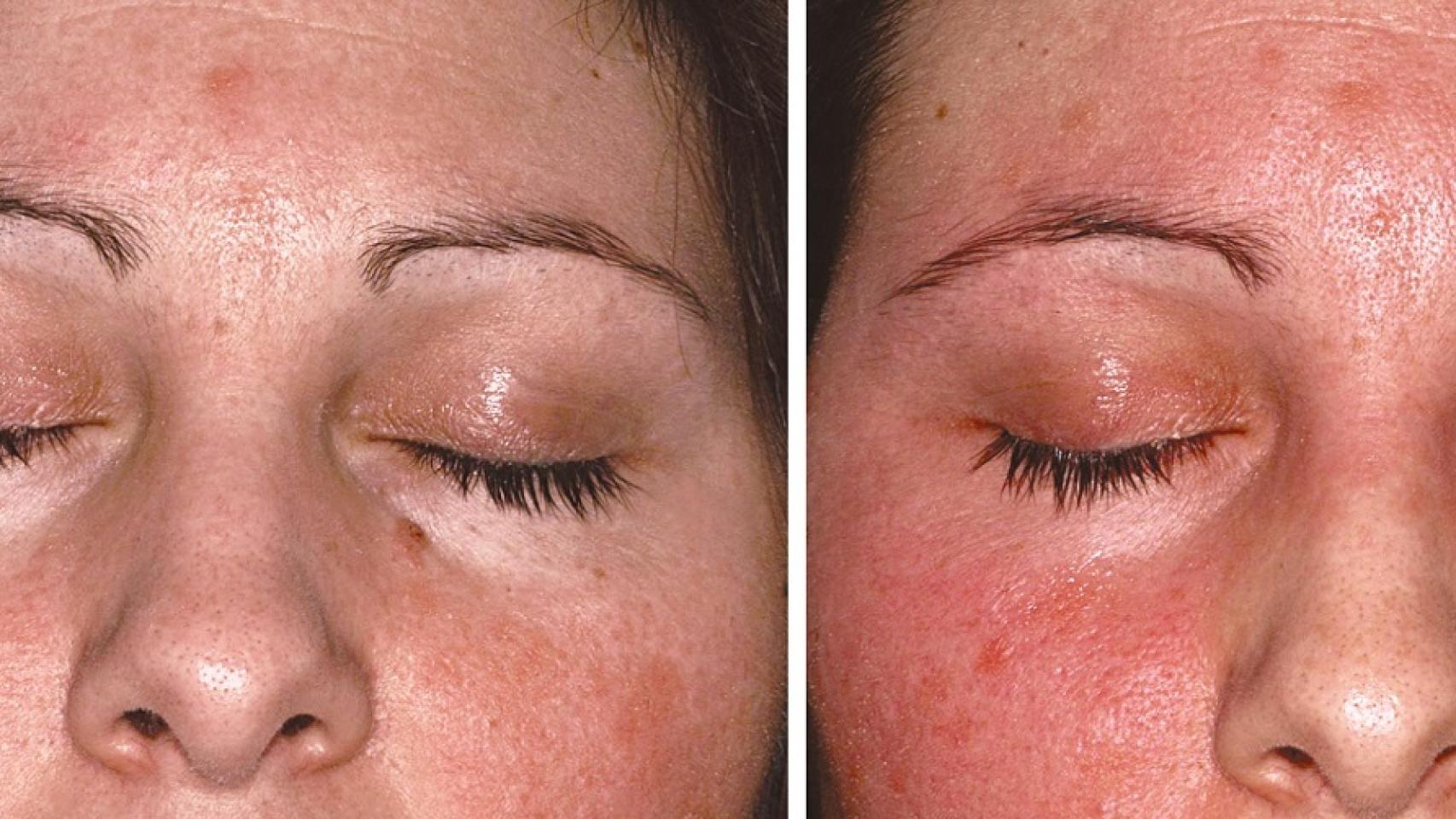 Ponerse rojo tras el vino no siempre es signo de haber bebido mucho.