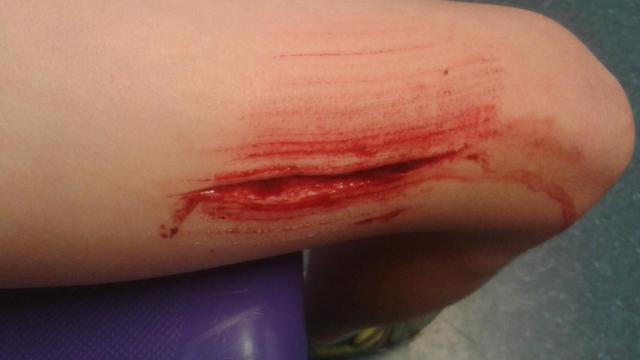 Una mujer con una herida en la pierna.