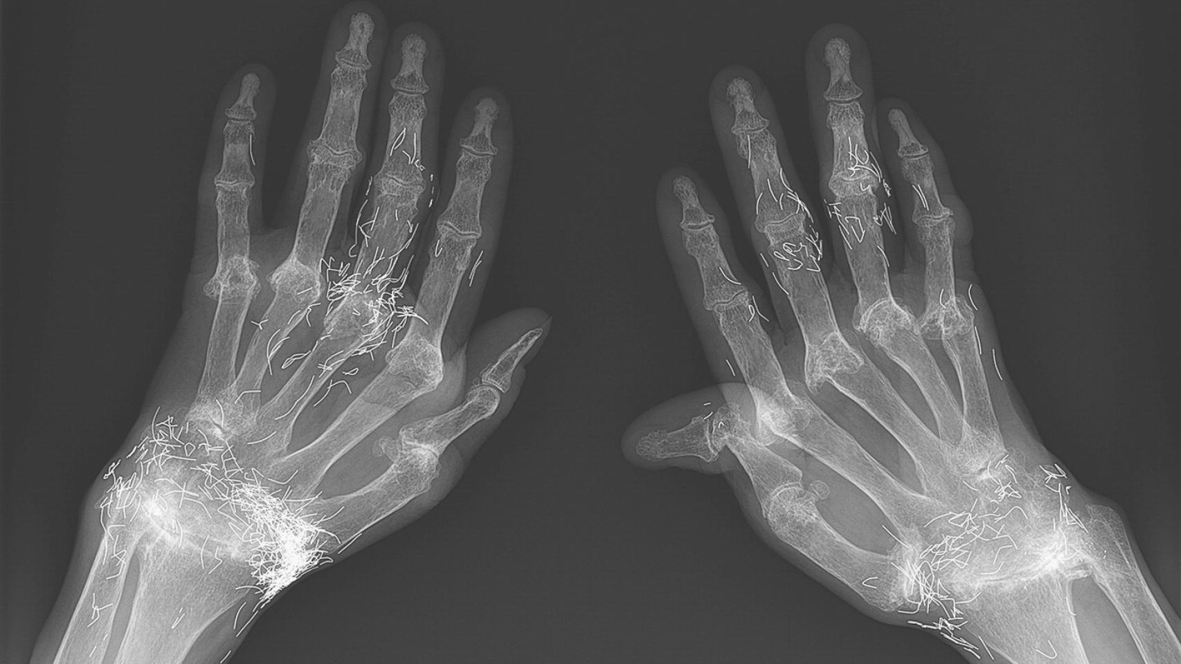 La radiografía de las manos de la mujer.