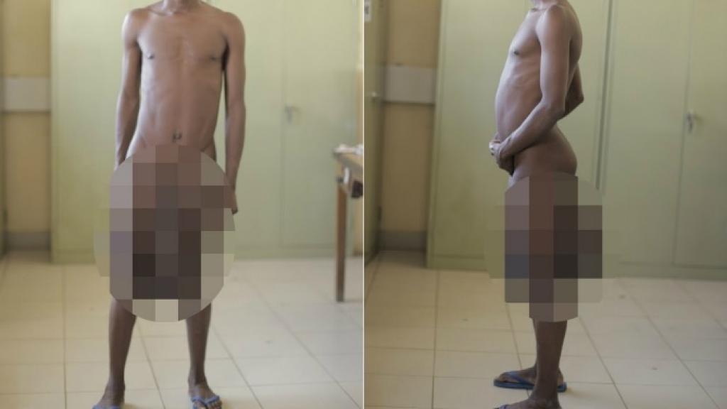 Forence sufría elefantiasis escrotal, una enfermedad que le provocaba tremendos dolores.