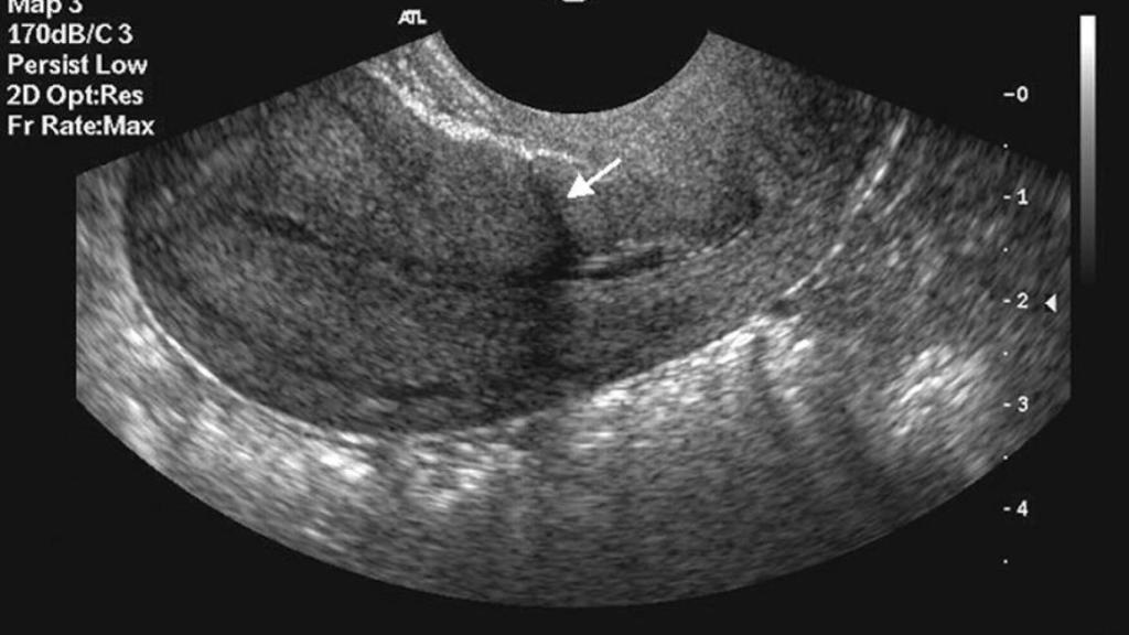 Un embarazo en la cicatriz de cesárea.