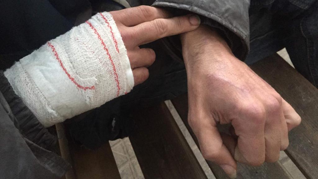 Billy muestra sus manos con las venas dañadas por los chutes