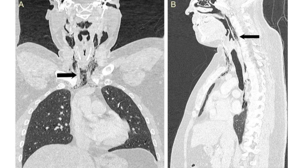 Los enfisemas localizados en el cuello y pecho del paciente.