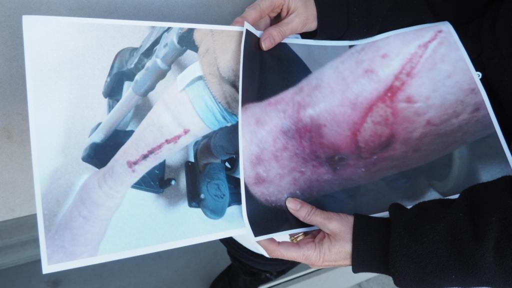 “Parece que le haya cogido un toro. Siempre son gruesas, como de un dedo de grosor, y aparecen de rodillas hacia abajo. Algunas miden 10 centímetros.