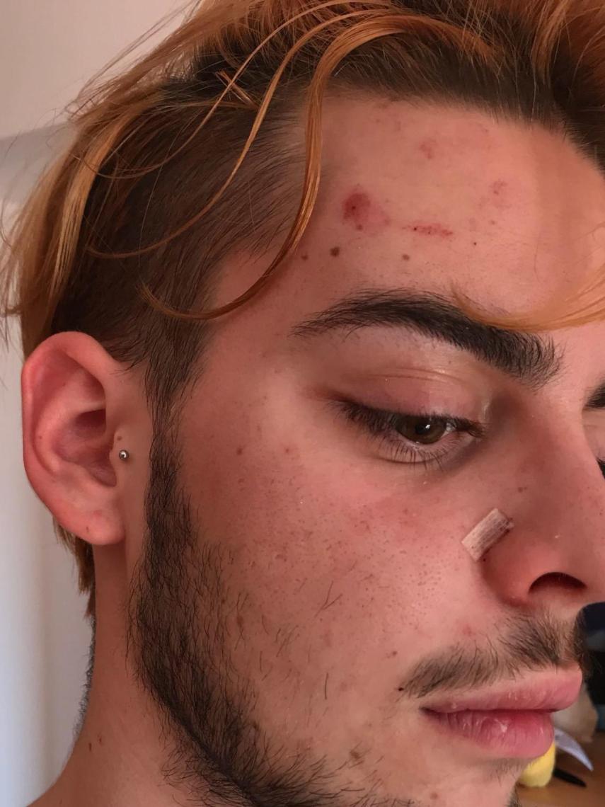 Pedro, tras la agresión.