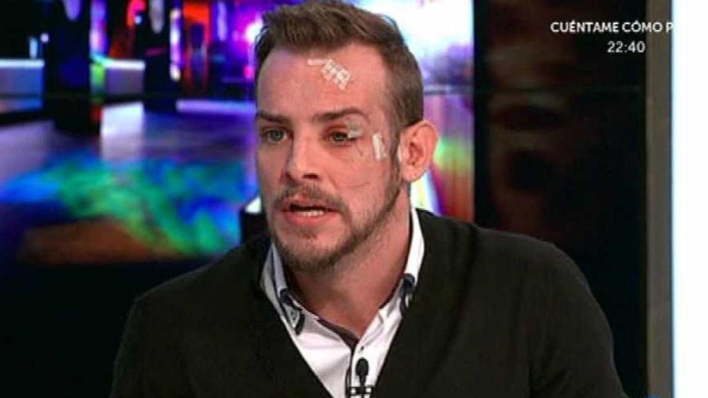 Álex Casademunt con la cara destrozada.