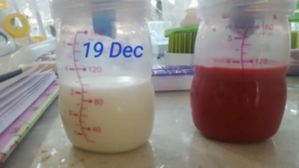 Así es la leche roja de una madre afectada.
