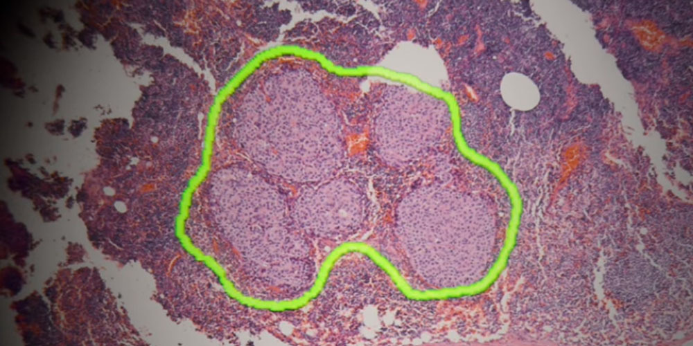 microscopio realidad aumentada google inteligencia artificial tumores