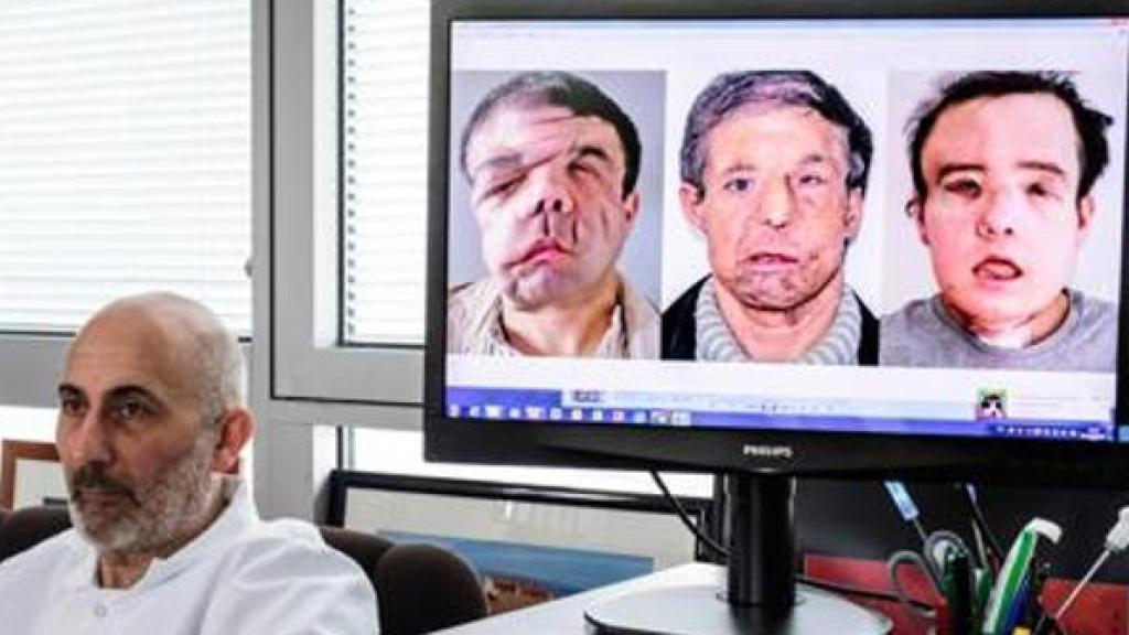 El cirujano Laurent Lantieri muestra la evolución de Jerôme Hamon.