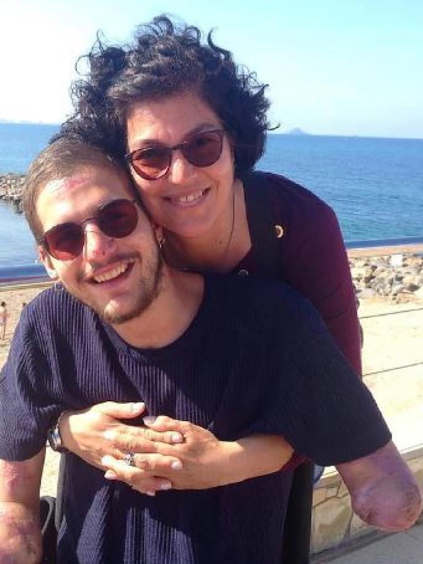 Davide una vez recibió el alta hospitalaria. Le raparon el pelo en Urgencias y se puede observar uno de sus muñones.