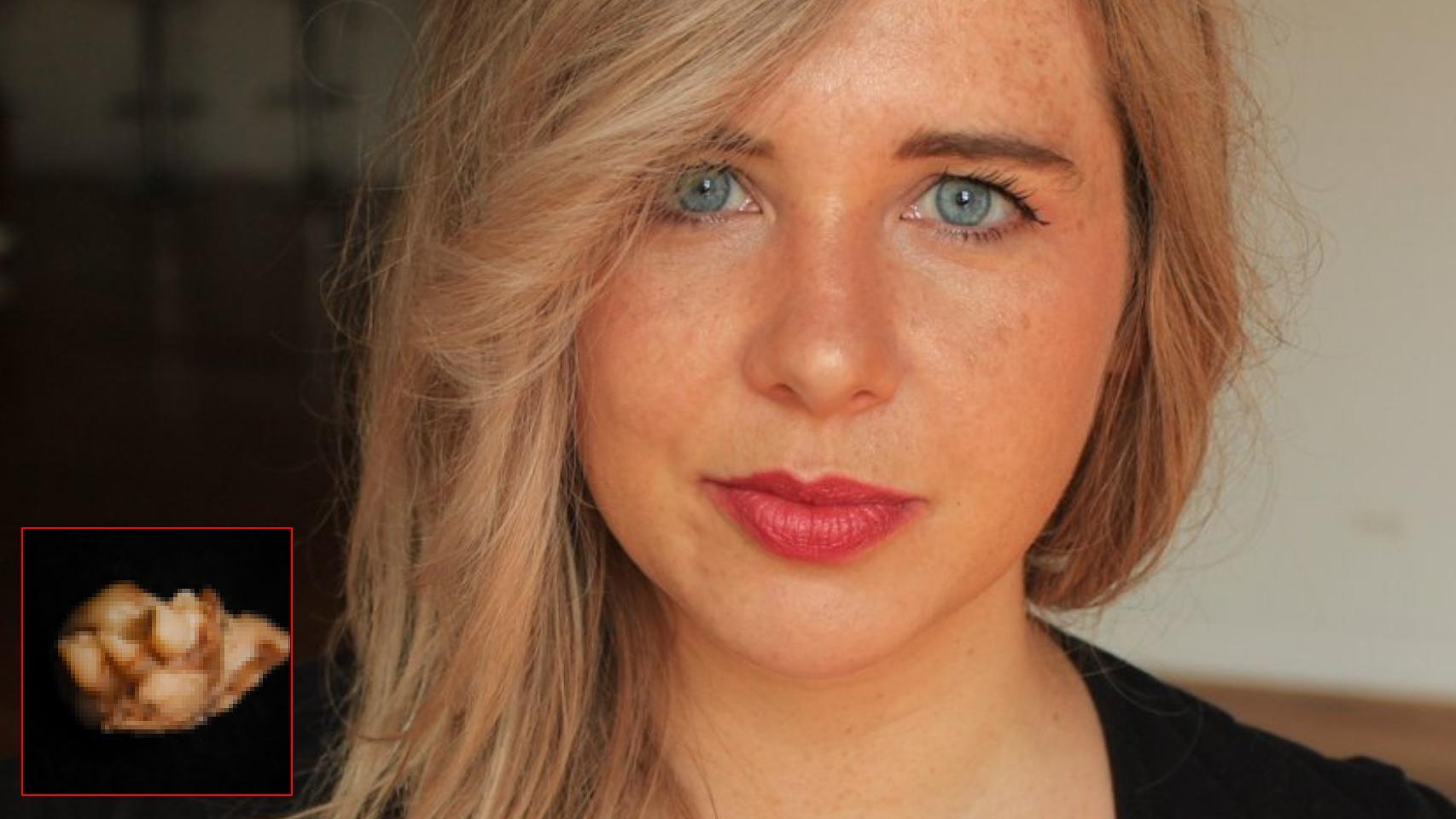 La autora Calle Hack. En detalle, un quiste dermoide de ovario con dientes y pelo.