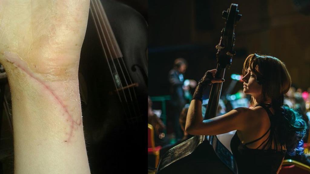 La lesión y el guante de electroestimulación que forman parte de la historia de Olga.