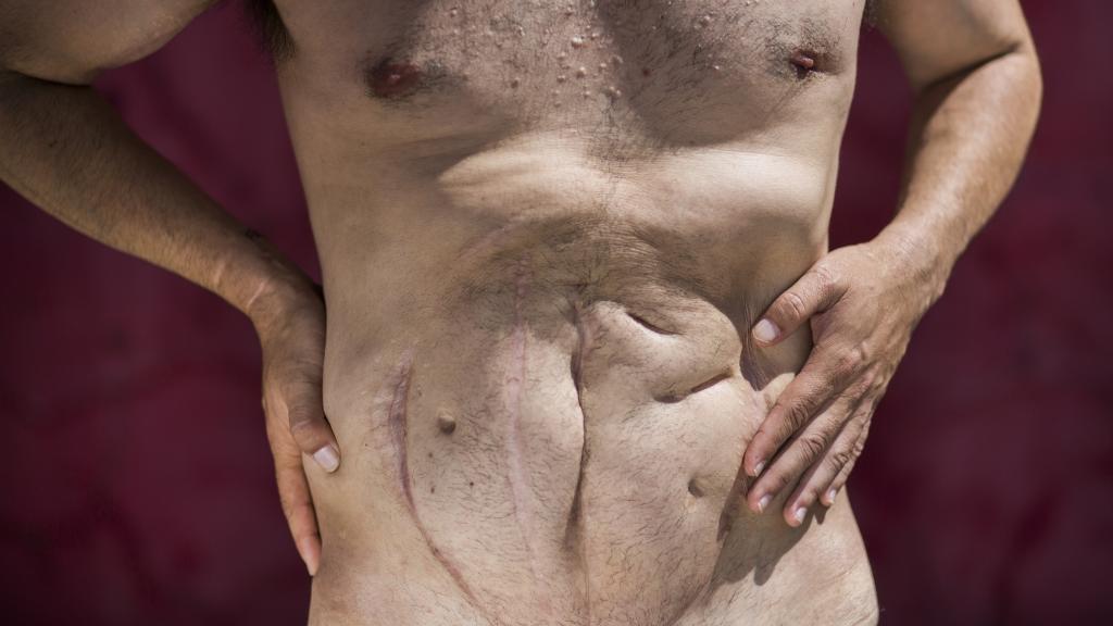 Detalle de las múltiples cicatrices de Luis.