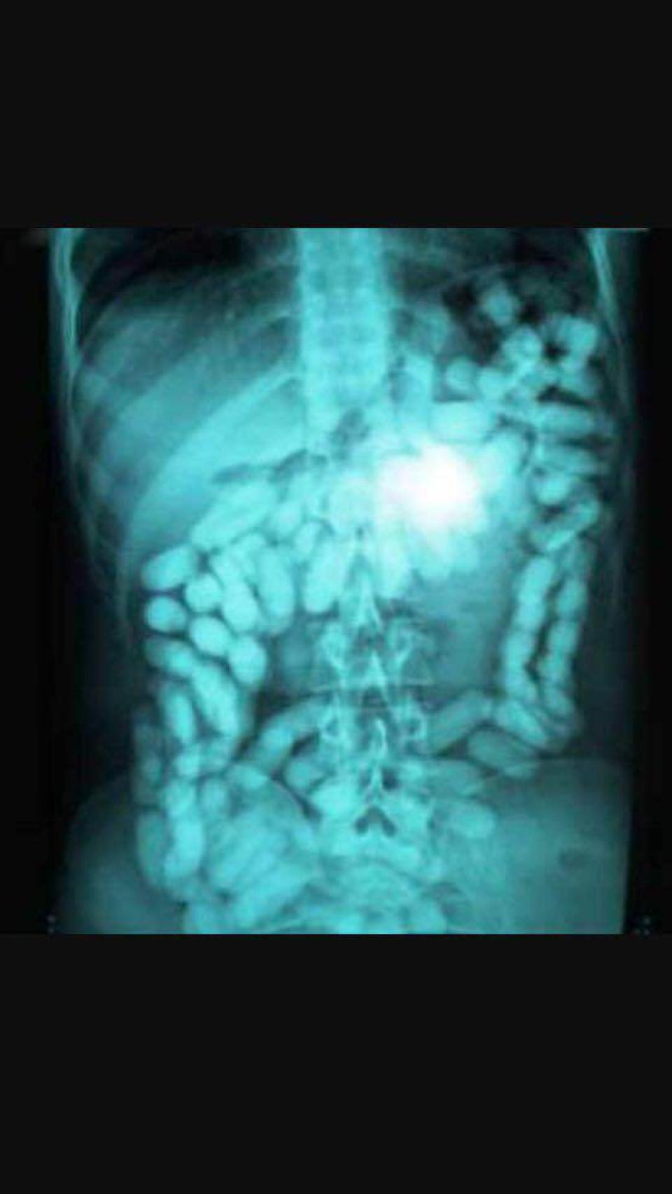 Una radiografía que muestra cómo se introduce la droga en los penales: dentro del cuerpo