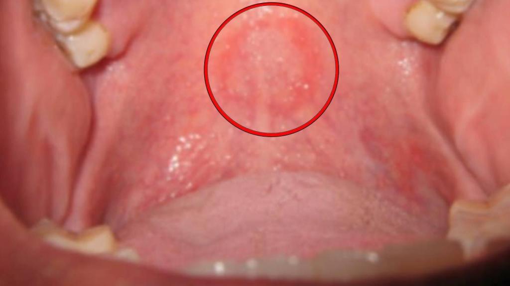 La imagen de la lesión en el paladar del paciente.