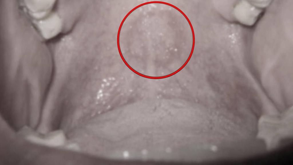 El eritema apreciable en el paladar blando del paciente.