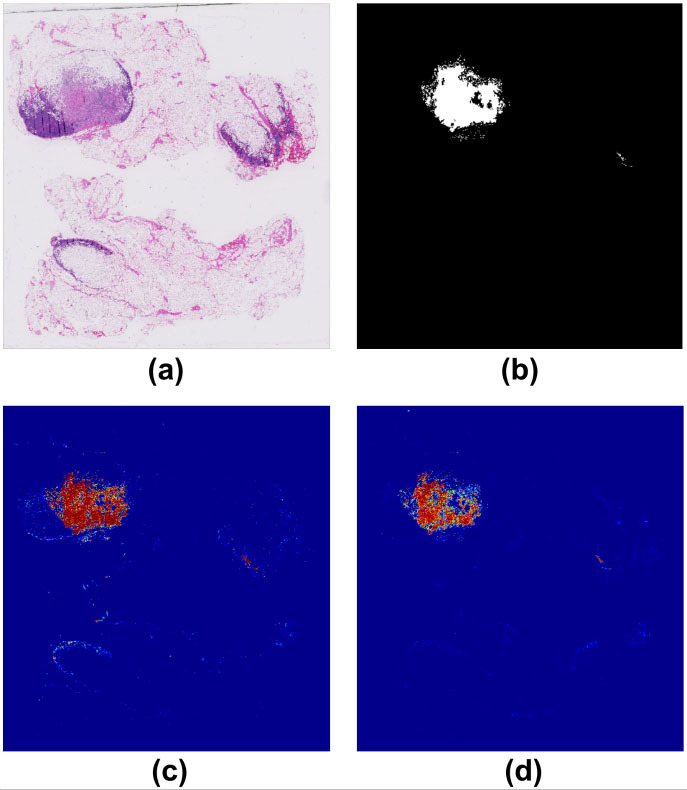 metastasis cancer deteccion de tumores baidu inteligencia artificial