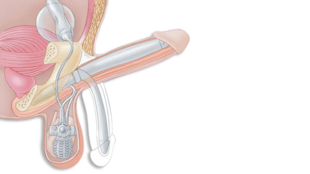 Las partes de un implante de pene.