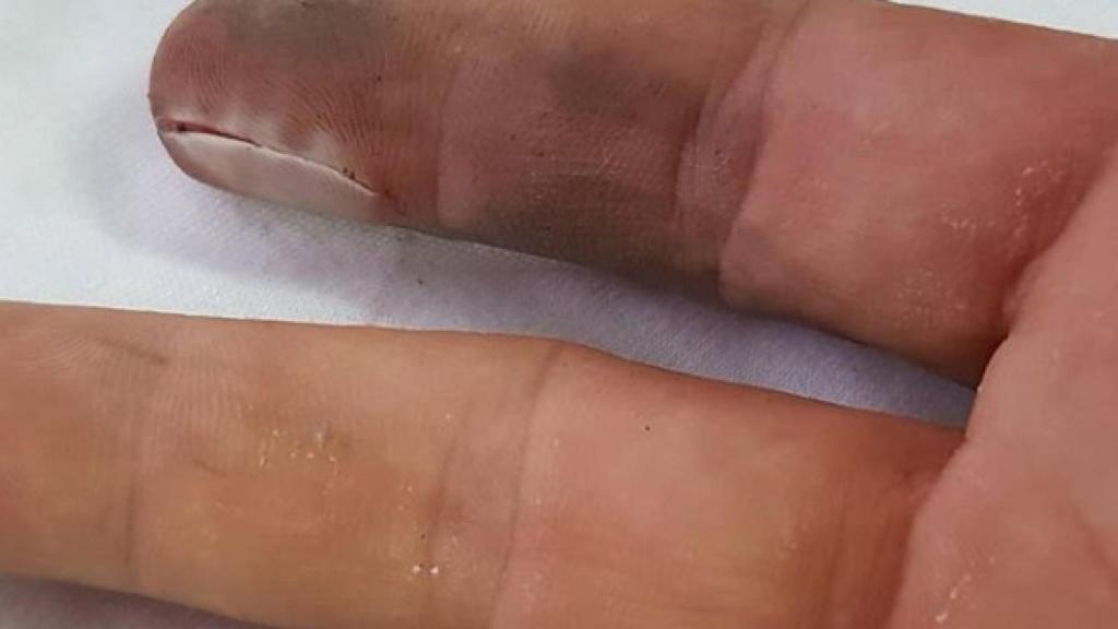 Estado actual del dedo tras pasar cinco días del accidente.