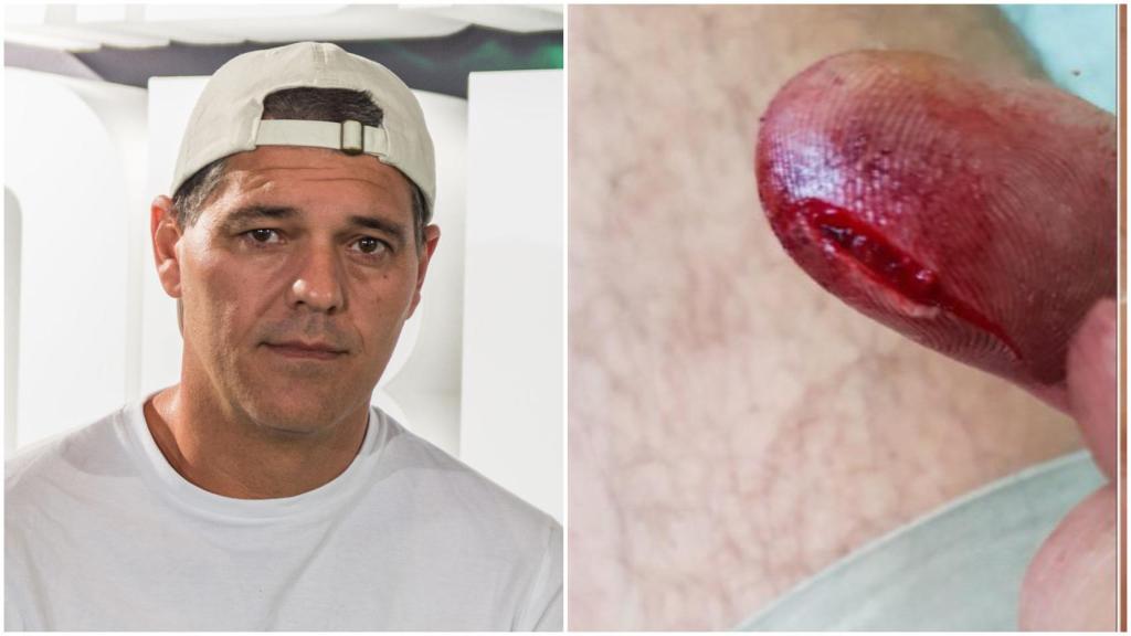 Frank Cuesta en un montaje de Jaleos junto a la herida de su dedo.