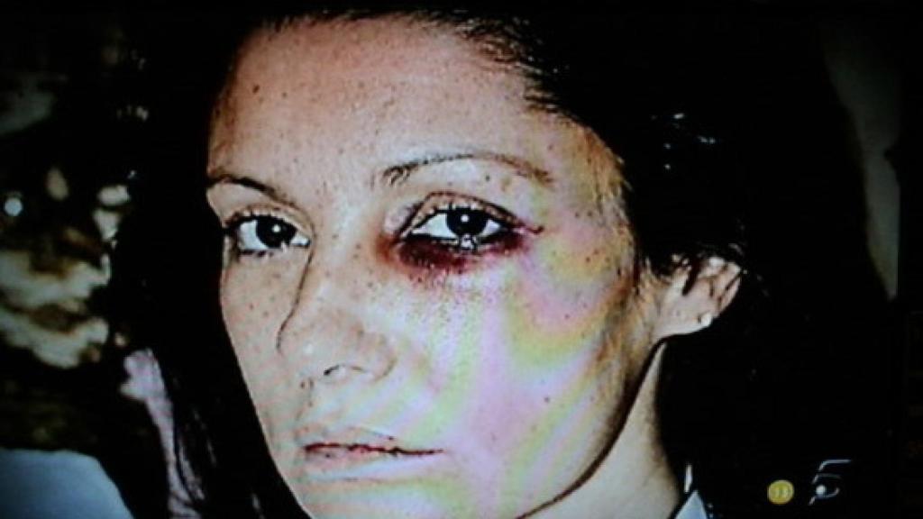 Carmina Ordóñez con el ojo amoratado.