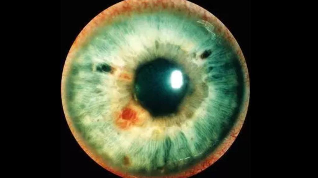 Uveitis sifilítica.