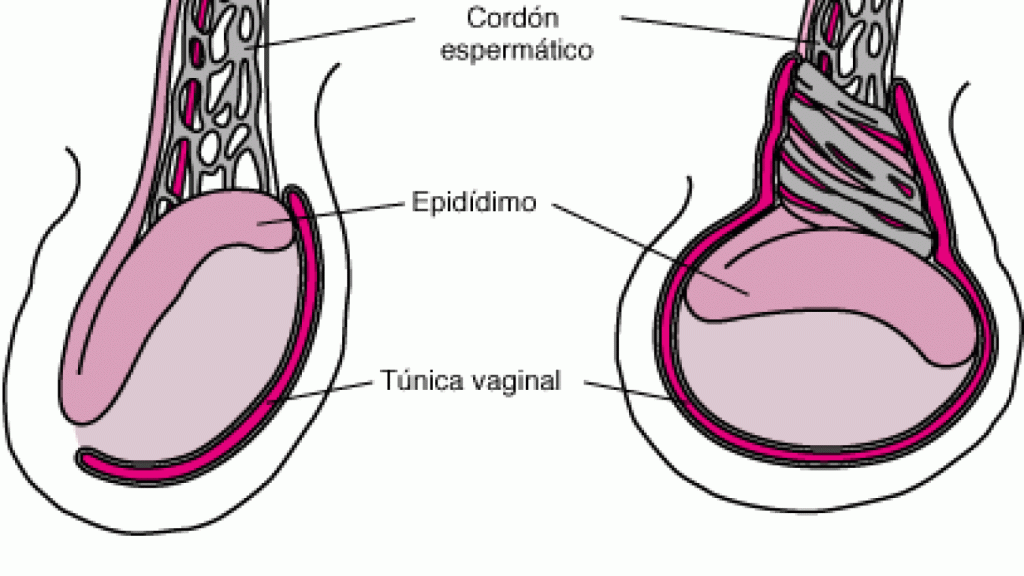 Ejemplo de una torsión testicular.