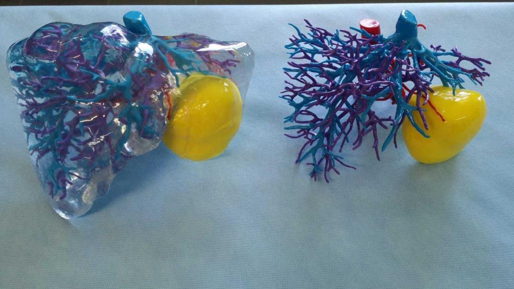 Modelo físico a escala real del hígado y la lesión de un paciente.