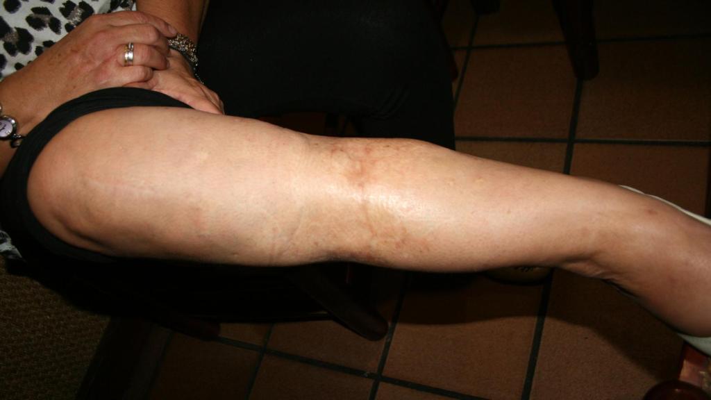 Pierna de la tiroteada.