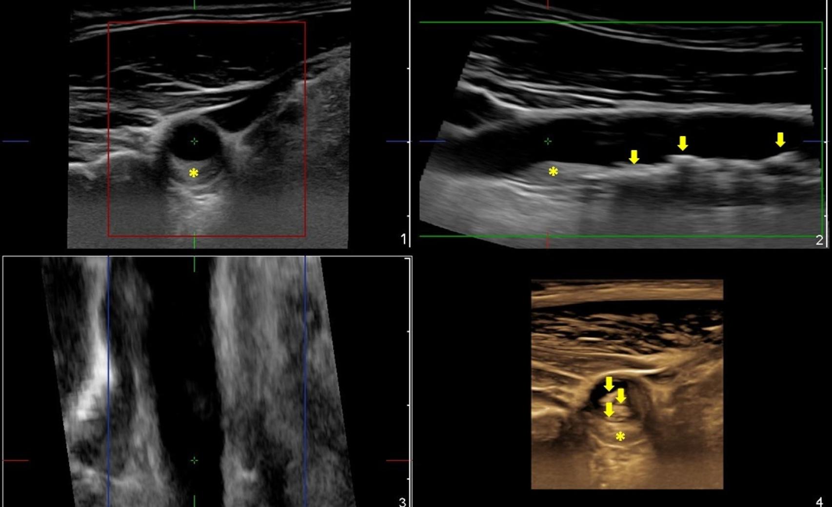 En este caso se aprecia una extensa afectación por aterosclerosis observándose varias lesiones, una primera placa (Foto 1) que ocasiona en mayor medida la obstrucción de la luz del vaso, y varias placas indicadas con flechas (Foto 2) que, no siendo obstructivas, son las más extensas. En la imagen en 3D (Foto 4) se pone de manifiesto cómo podemos valorar la presencia, disposición, extensión y grado de obstrucción de todas las placas, lo que nos da una idea más precisa del daño por aterosclerosis en un único estudio. (Valoración de la Dra. Beatriz López Melgar).