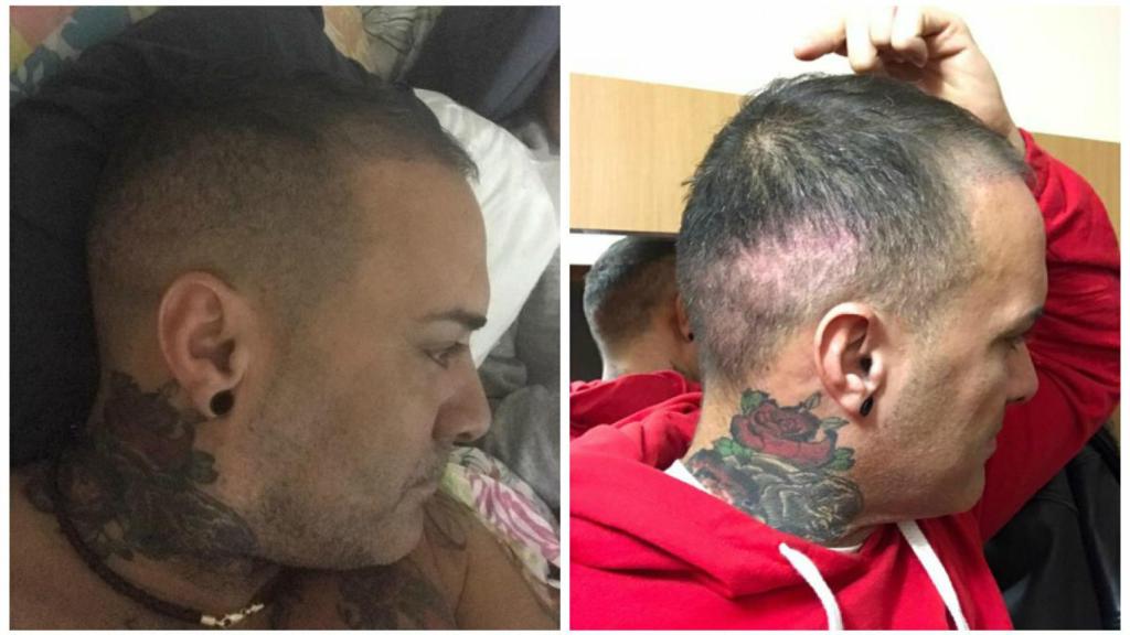 El ahora y el antes del injerto de Dinio.