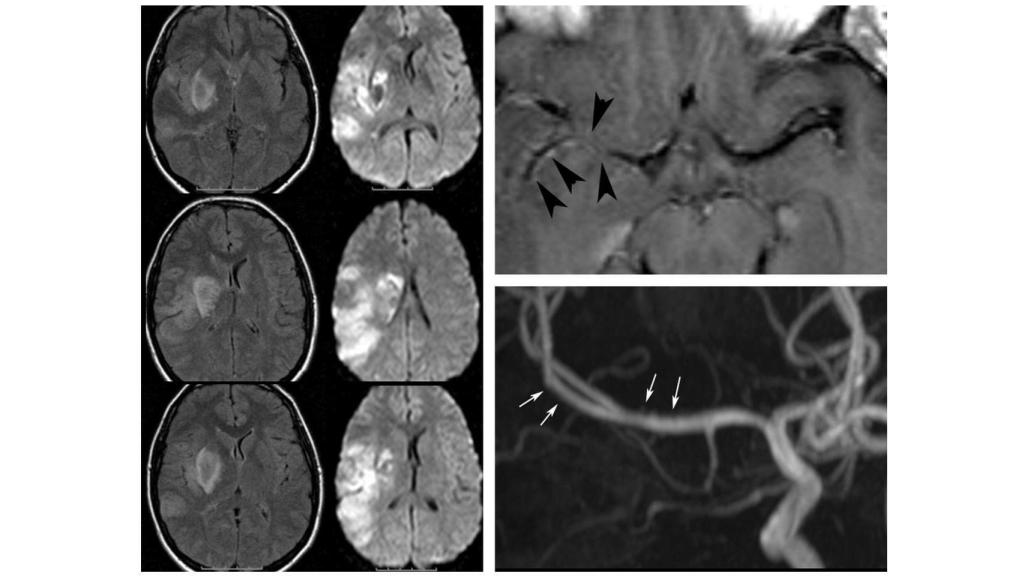 Hemiplejia (parálisis de un lado del cuerpo) por consumo de cocaína. Ajnr.org.