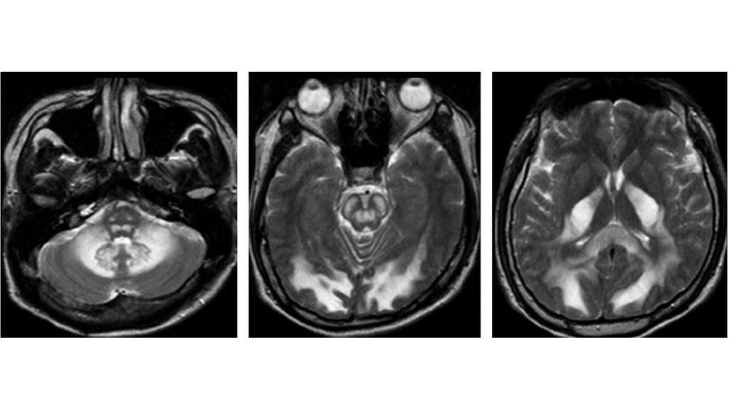 Destrucción de la materia blanca en un consumidor crónico de heroína, lo que provoca deterioro cognitivo. Ajnr.org