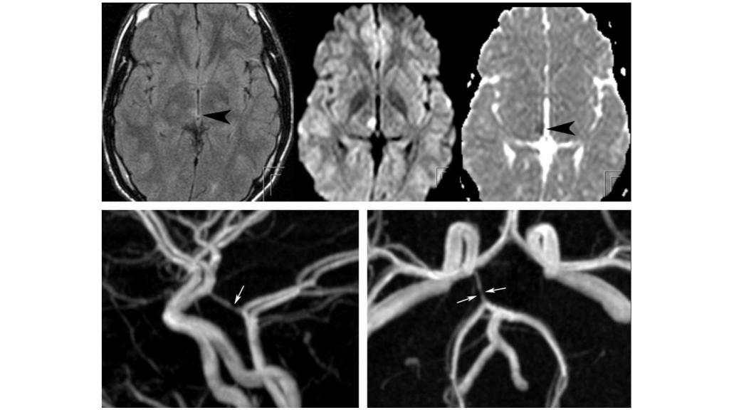 Déficit hemisensorial, posible causa de parálisis cerebral, provocado por el uso de fármacos. Ajnr.org