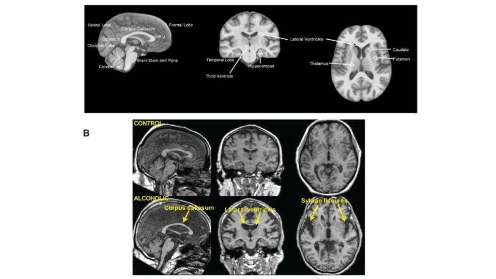 Daños en las regiones del cerebro provocados por el alcoholismo. Niaaa.nih.gov